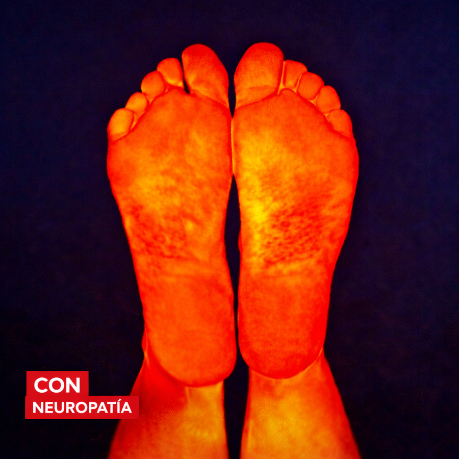 Antes, con neuropatía